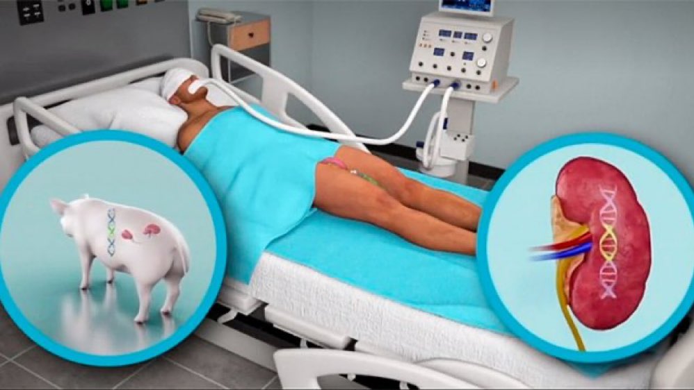 Cirujanos de EE.UU. transplantan un riñón de un cerdo modificado genéticamente a un paciente vivo