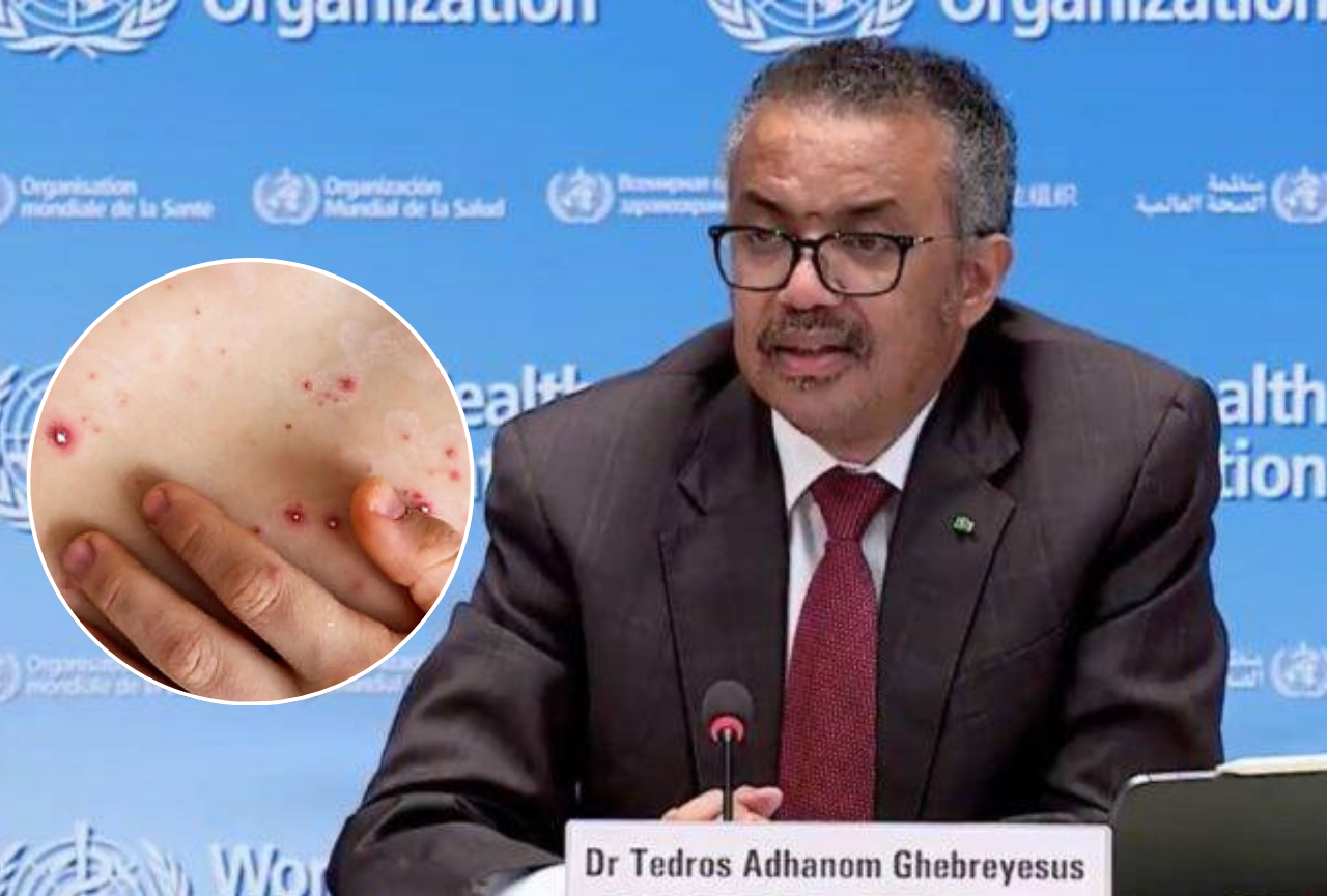 La OMS declara la viruela del mono como emergencia sanitaria de interés internacional